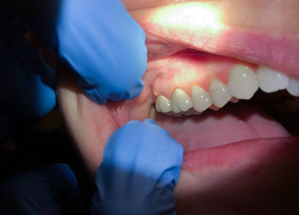 Best Knocked-Out Tooth Emergency  in Lancaster, TX
